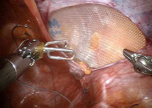 Keyhole Surgery For Gallbladder Stone